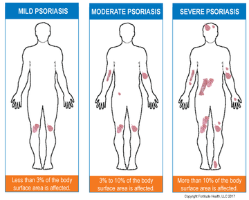 What Are The Causes of Psoriasis?