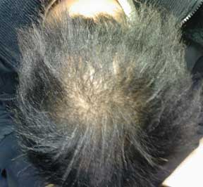Scalp Psoriasis Hair Loss