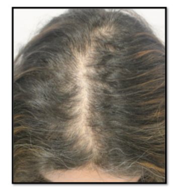 Can Scalp Psoriasis Cause Hair Loss?