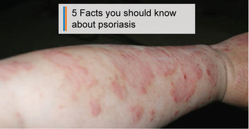 5 Facts You Should Know About Psoriasis