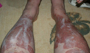 Psoriasis Cream with Salicylic Acid & Coal Tar