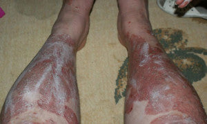 Can Psoriasis Occur Anywhere On The Body?