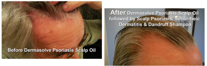 How To Get Rid Of Scalp Psoriasis With Over-The-Counter Products