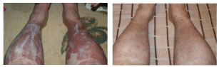 What is the Best Psoriasis Treatment?
