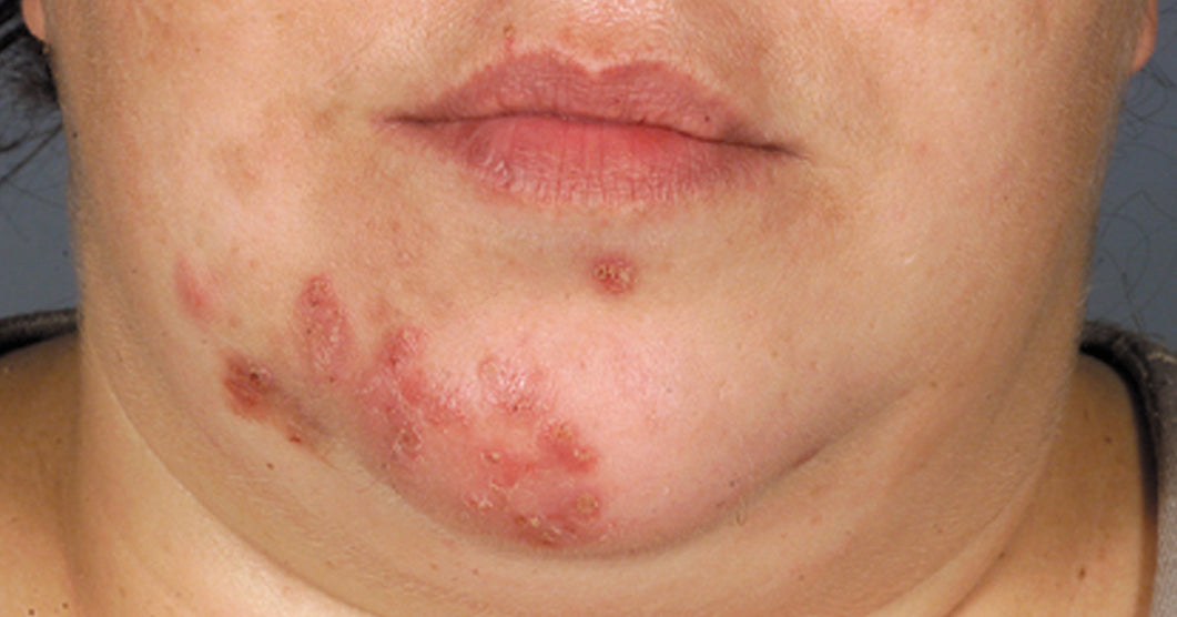 What are the Signs of Psoriasis?