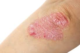 What is Plaque Psoriasis?