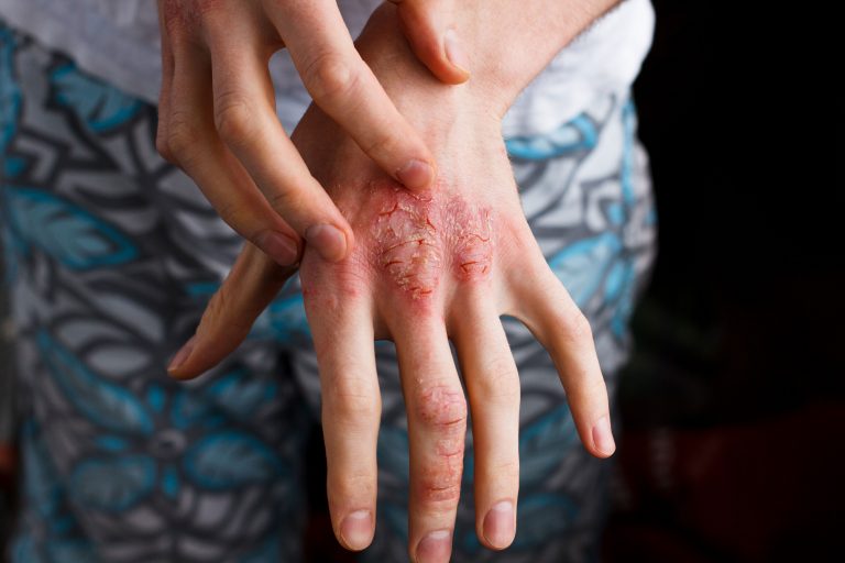 A compound derived from immune cells is being tested to treat psoriasis
