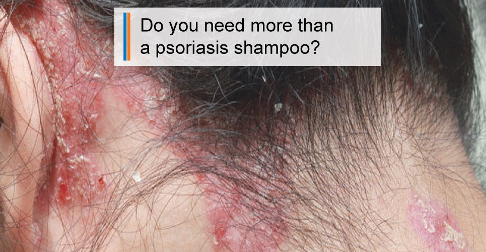 Do You Need More Than a Scalp Psoriasis Shampoo?
