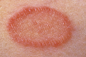 Are Psoriasis and Pityriasis Related?