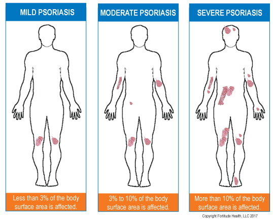 What Are The Causes of Psoriasis?