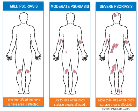 Severity Of Psoriasis Diagram ?v=1521744397&width=533
