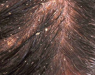 How does a Scalp Psoriasis Shampoo Work?