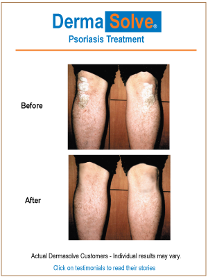 All 5 Dermasolve Psoriasis Products