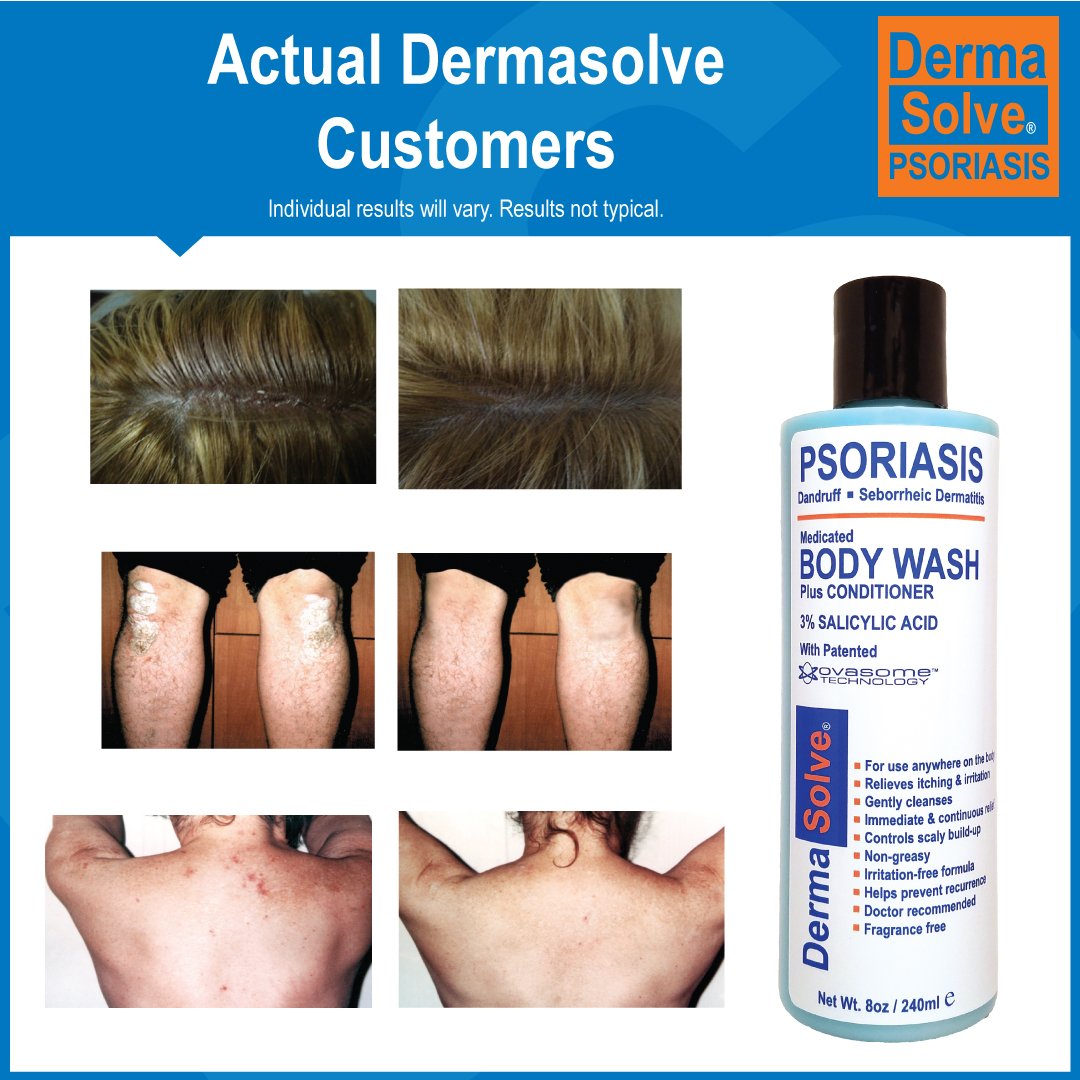 Body wash deals for psoriasis