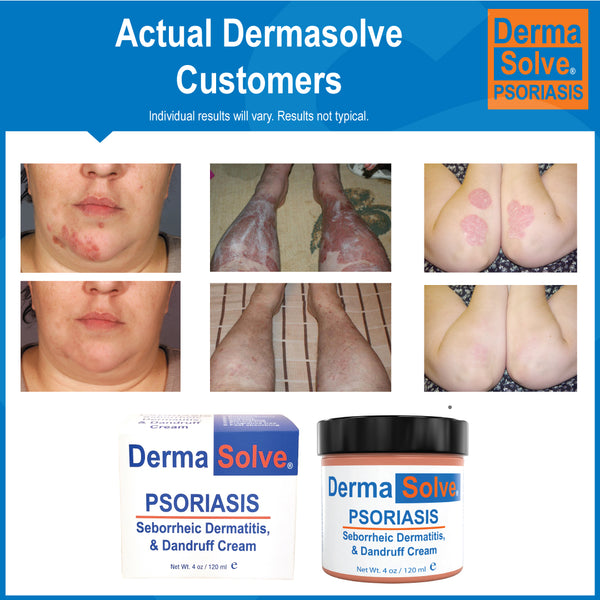Dermasolve Psoriasis Cream 4-Pack