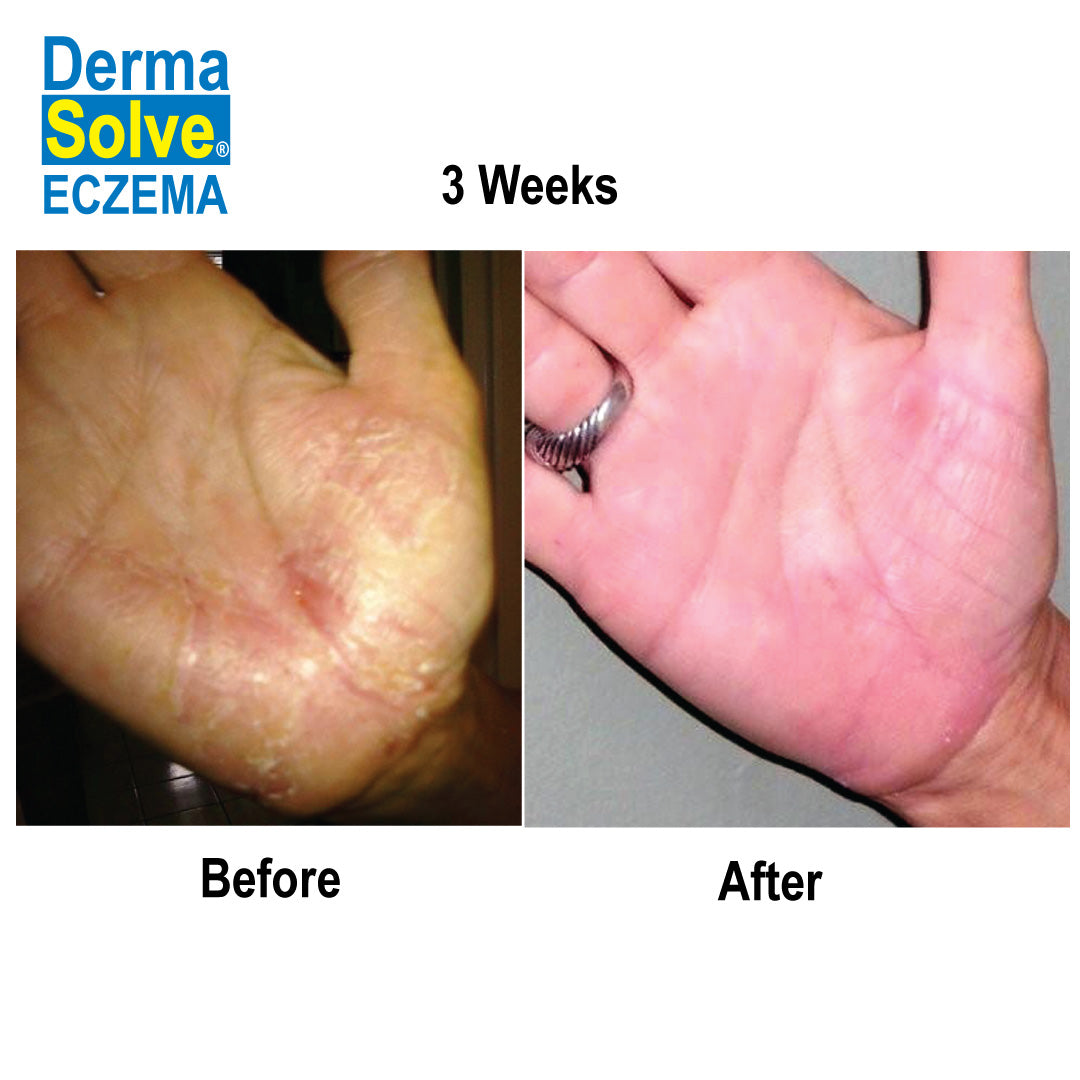 Dermasolve Eczema Complete Body and Scalp Kit